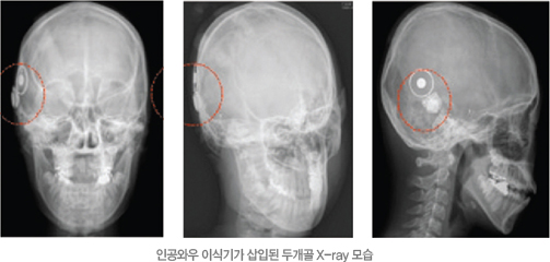 인공와우 이식기가 삽입된 두개골 X-ray 모습